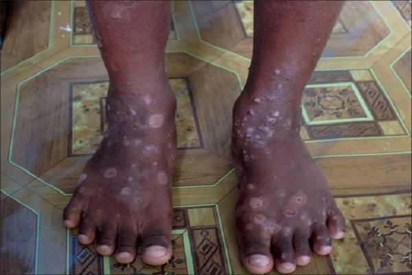 Namibian Health ministry confirms thousands of scabies cases