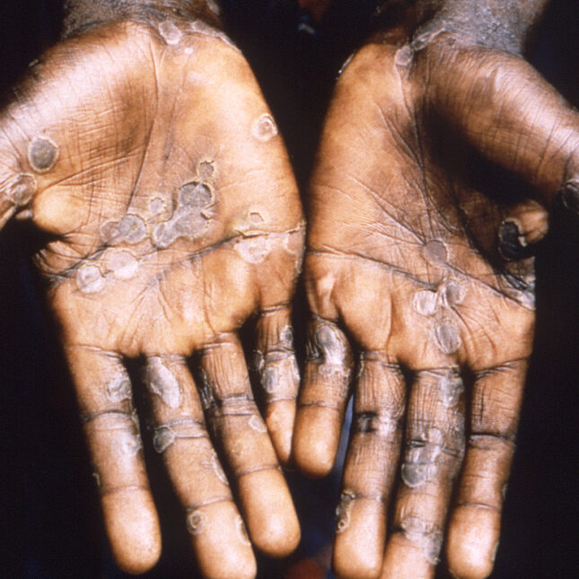 Monkeypox presents moderate risk to global public health, WHO says