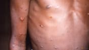 Massachusetts identifies first 2022 US case of monkeypox infection