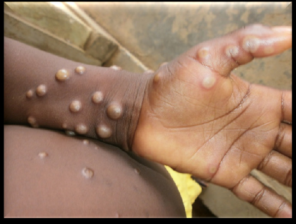 Monkeypox: Uganda isolates six, takes samples to South Africa for testing