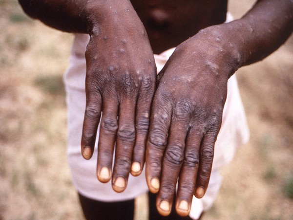 Man in Sao Paulo hospital with Brazil’s first monkeypox case