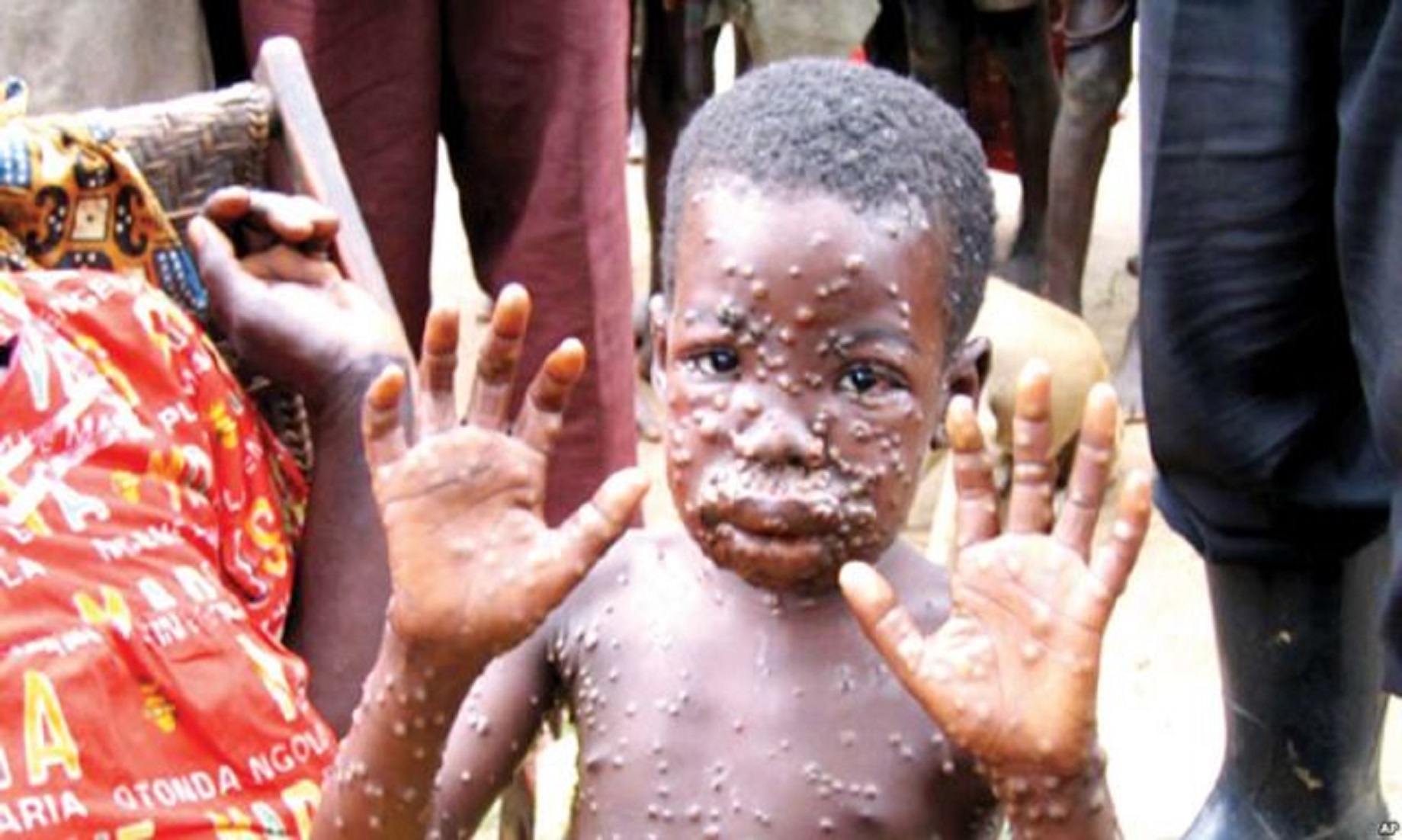 Monkeypox Cases Rise To 41 In Nigeria