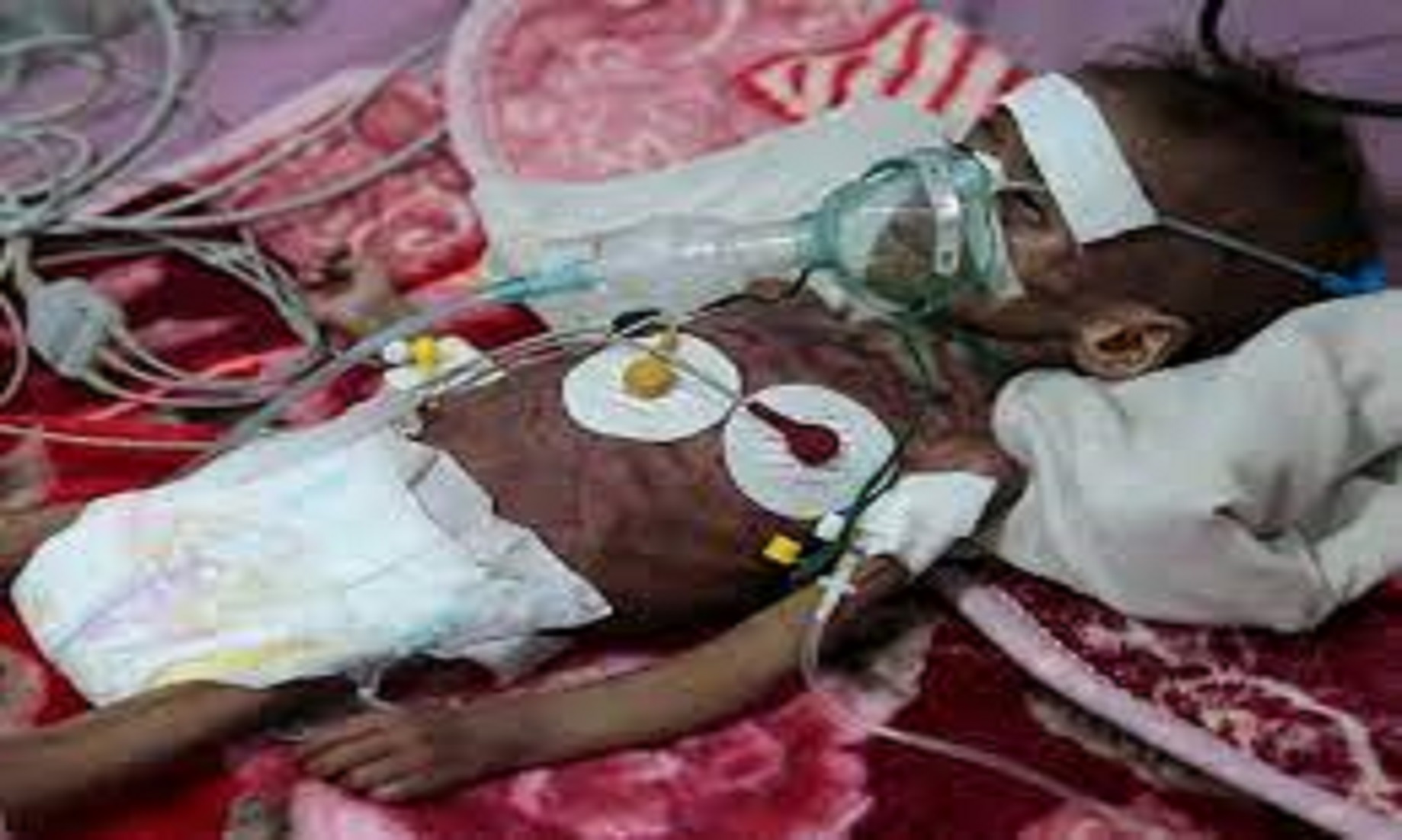 Millions Of Hungry People In Yemen Face Imminent Aid Cuts: UN