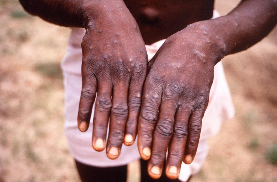 European festivals should not be scrapped due to monkeypox: WHO