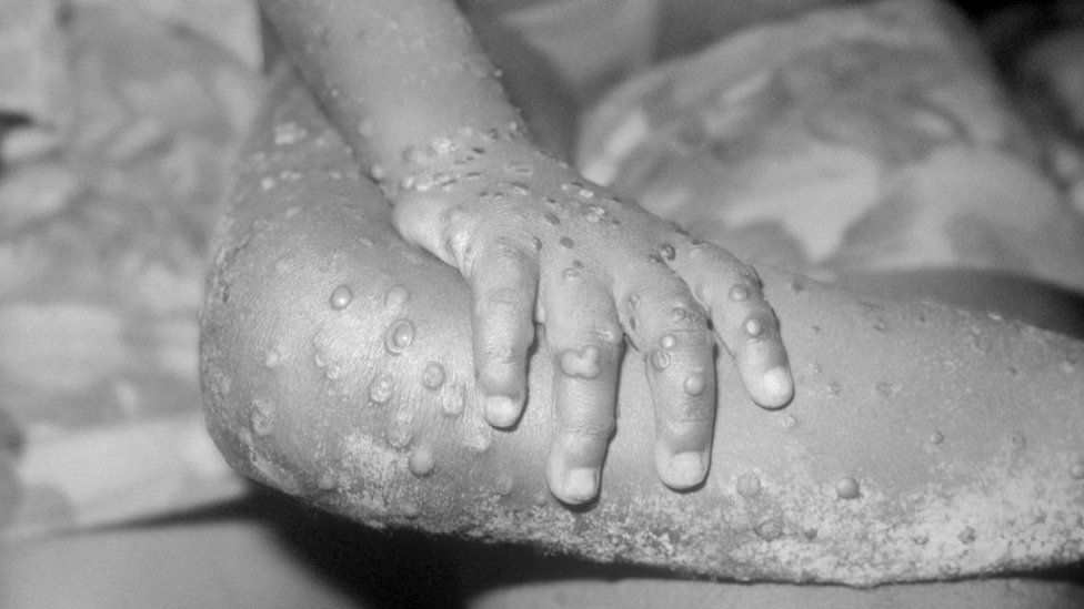 Monkeypox cases in Colombia rise to 5