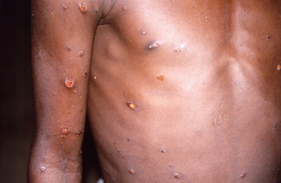 Major US areas sound alarm on monkeypox as nearly 5,000 cases reported nationwide