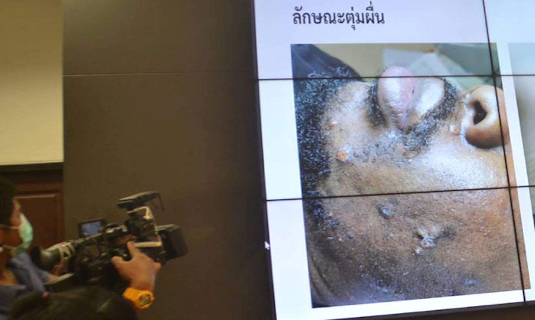 Monkeypox Patient From Thailand Found In Cambodian Capital: Deputy Governor