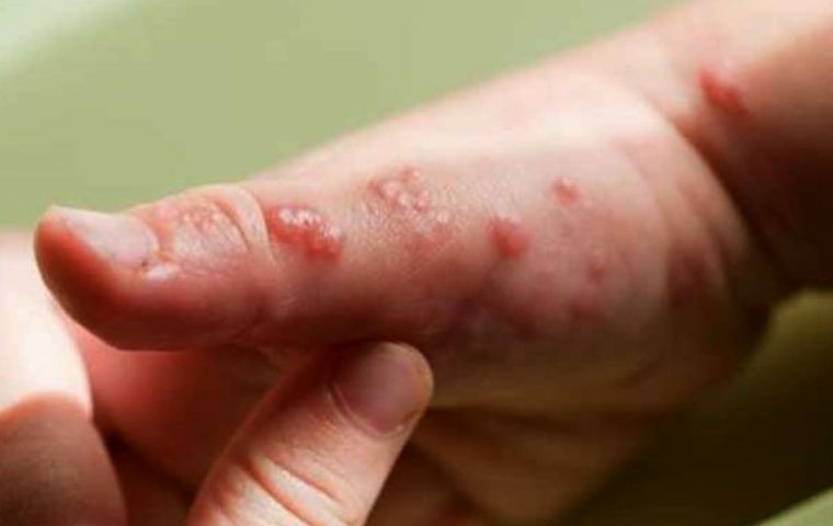 Cases of monkeypox soar in Peru