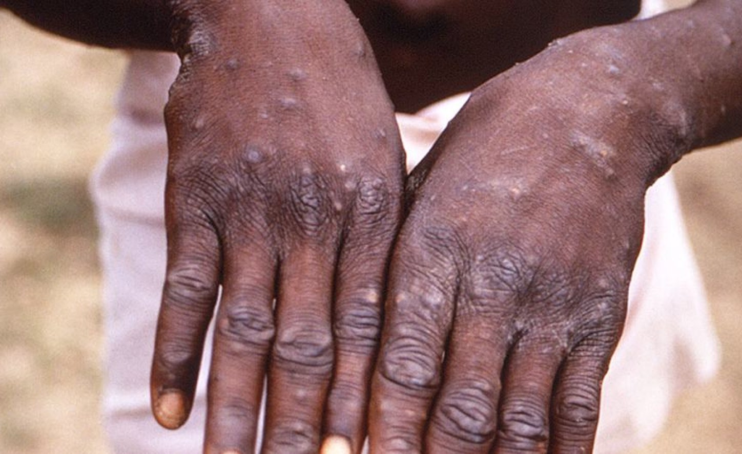 Nigeria records fresh 41 cases of Monkeypox in 7 days