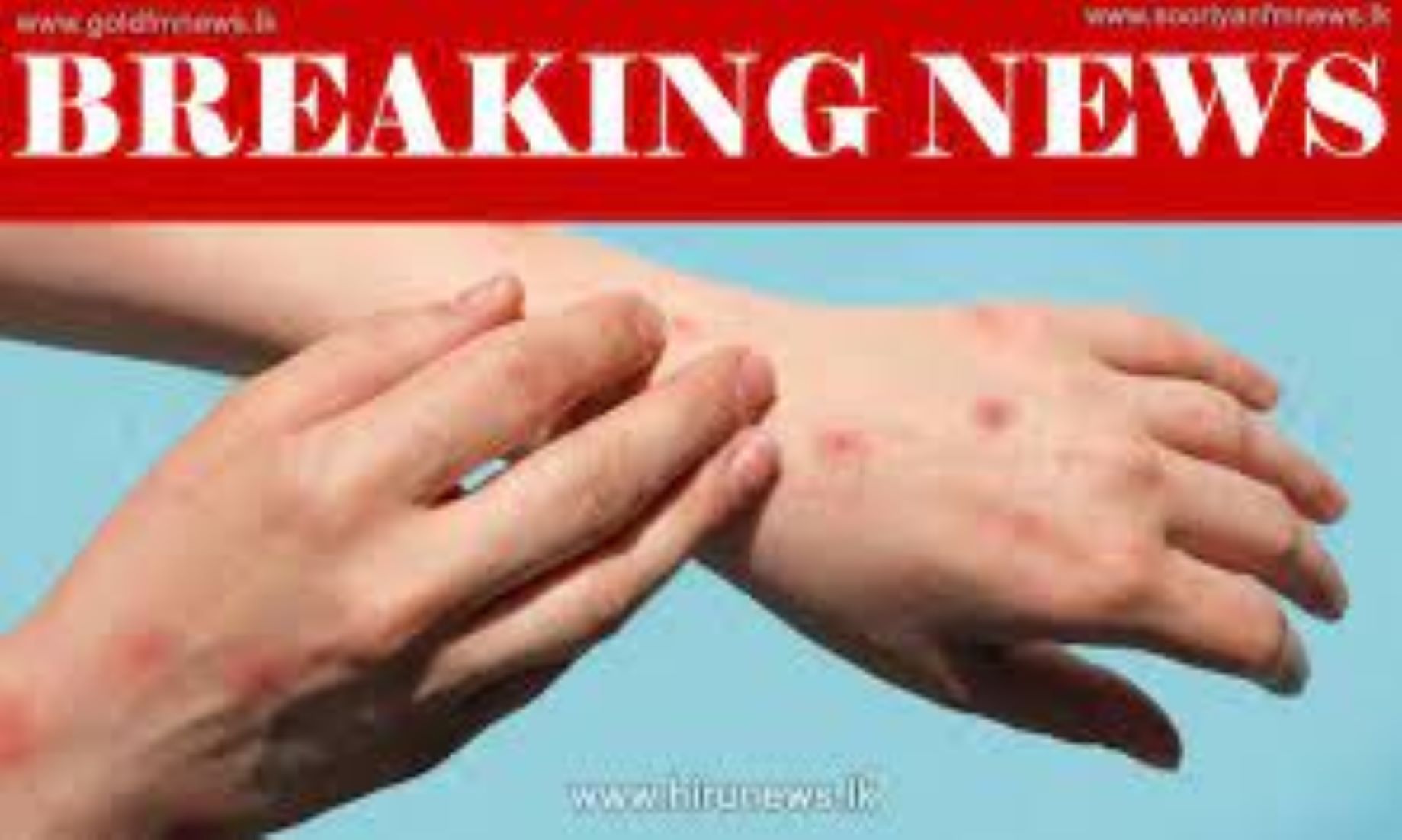 Sri Lanka Detected First Case Of Monkeypox