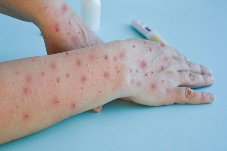 Mexico reports over 3,000 mpox cases and four deaths