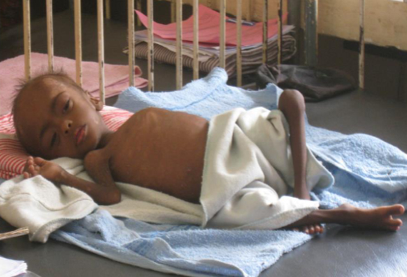 UN calls for urgent help to combat acute child malnutrition