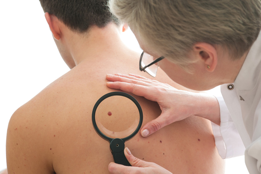 Day of the Mole: Cuba develops initiative for the early detection of skin cancer