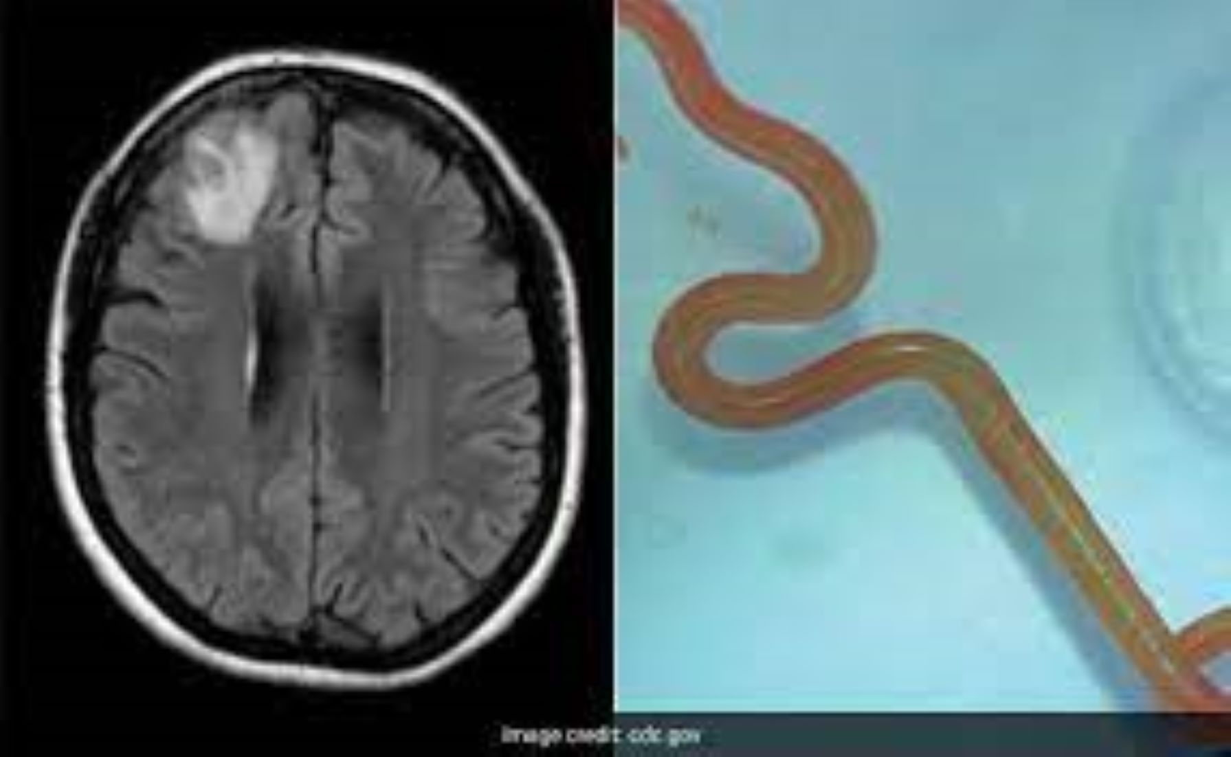 Live Worm Found In Woman’s Brain In Australia