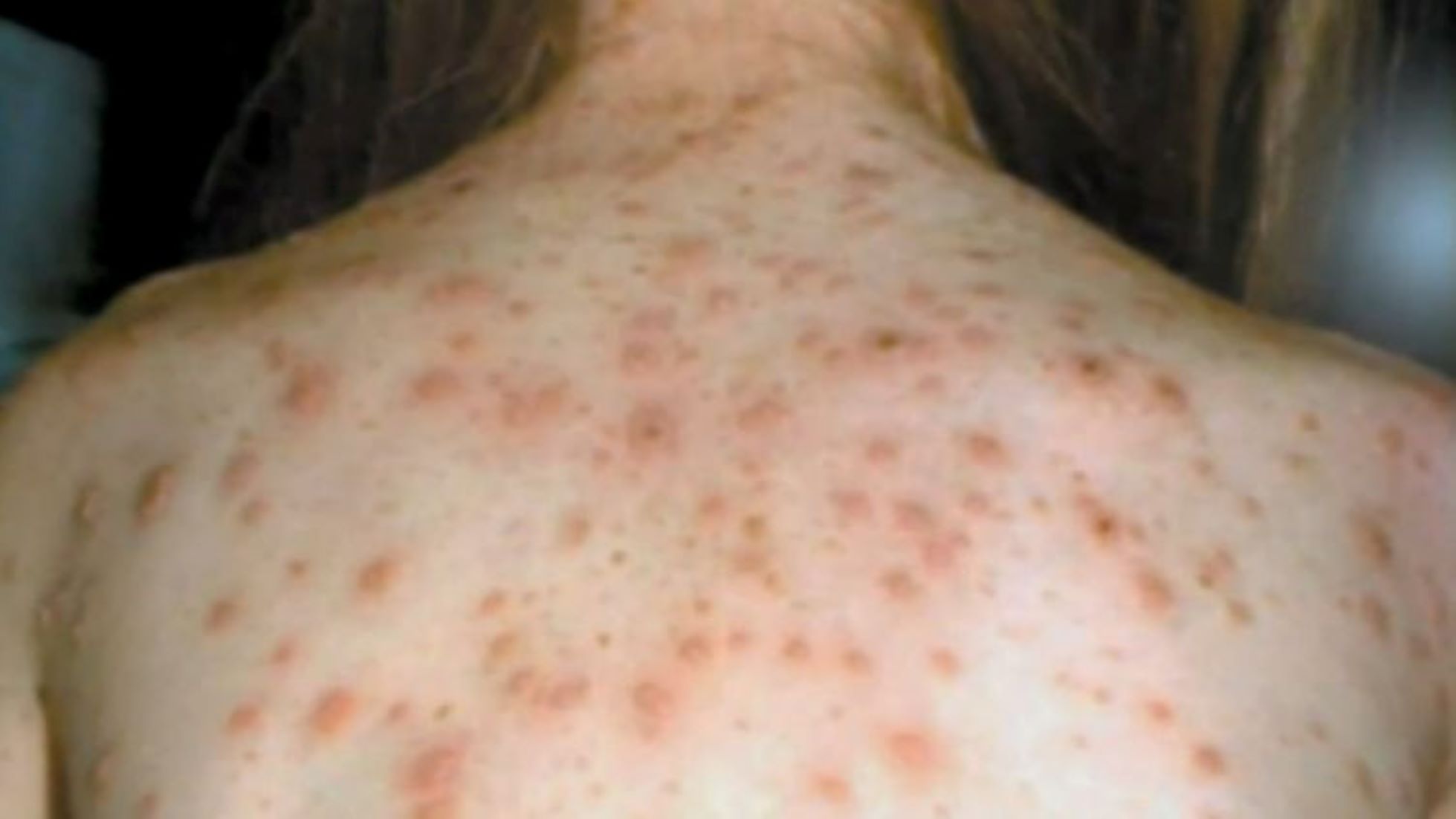 Western Australia In Statewide Alert After New Measles Case Confirmed