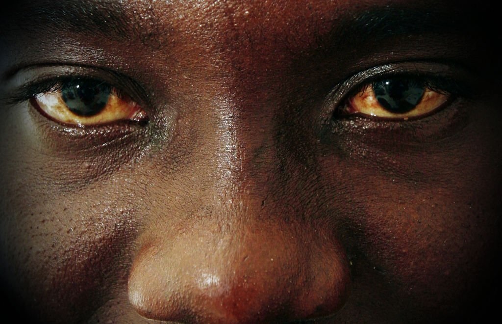 Rwanda issues red eye disease alert