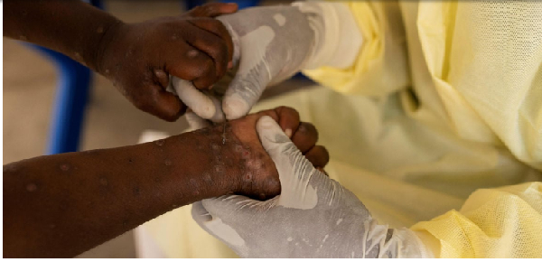 DR Congo reports 35 new Mpox deaths