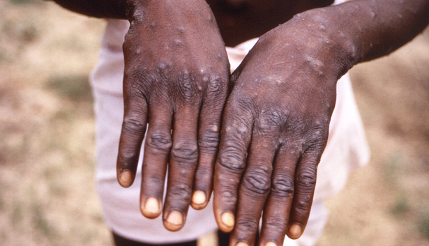 Africa’s CDC declares mpox a public health emergency