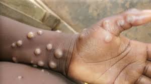 Burundi records 171 mpox cases