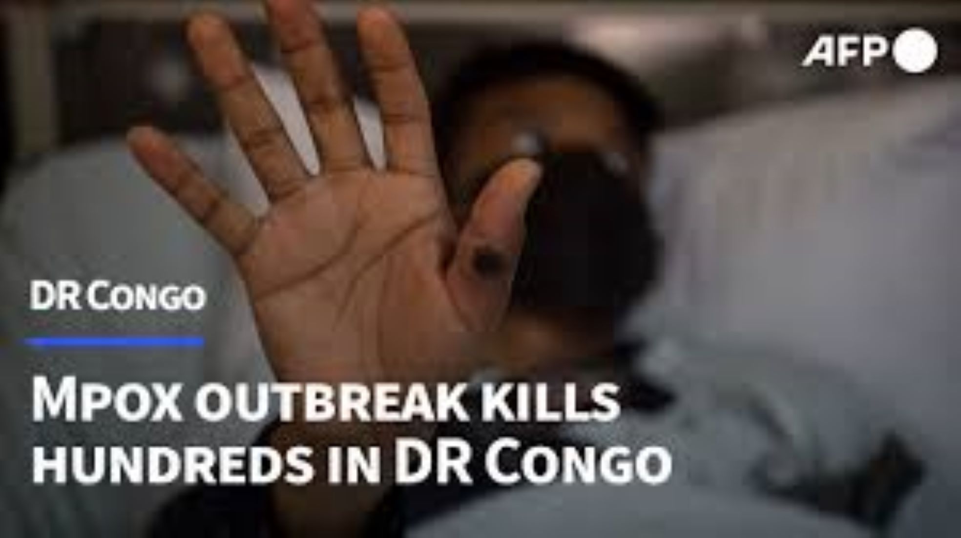 Mpox Kills Over 610 In DR Congo: Health Minister