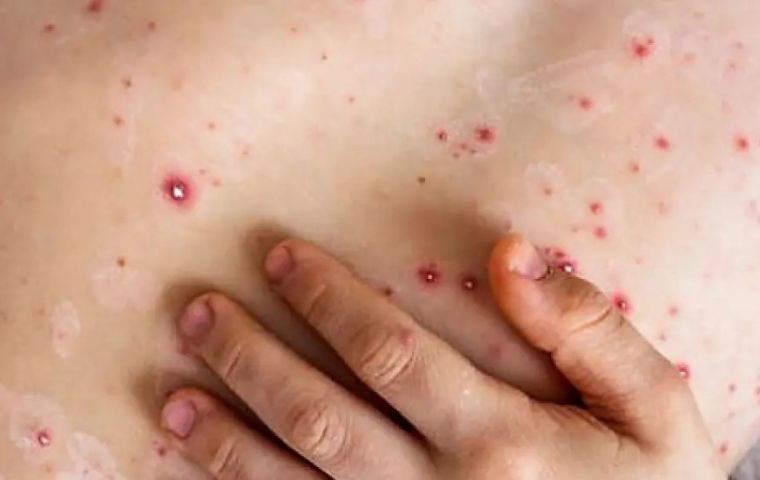 Brazil sets up special committee to tackle mpox crisis