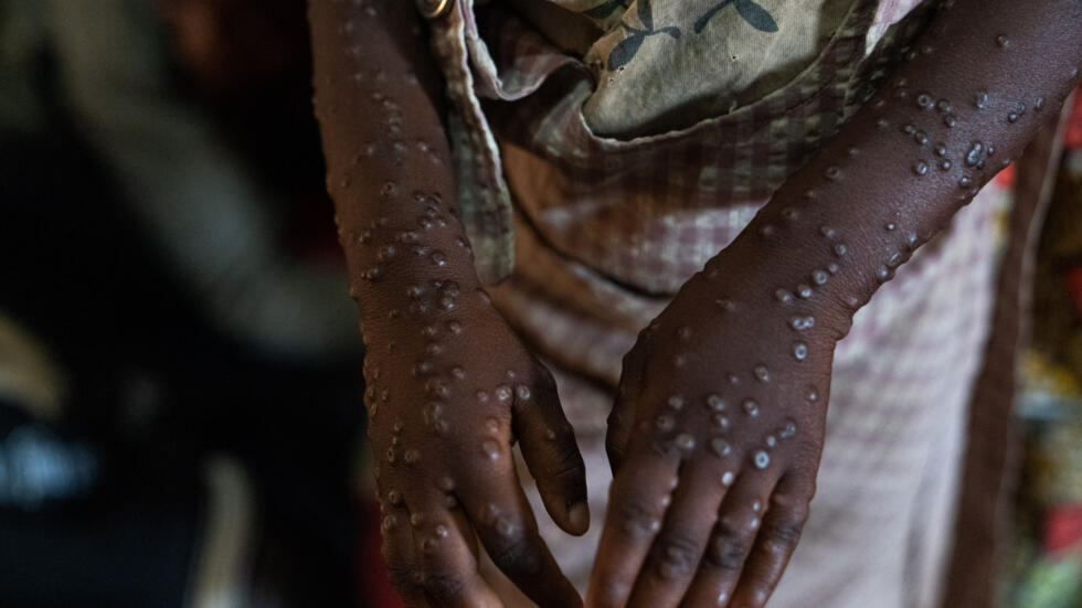 Third of Burundi mpox cases in children under five: UN