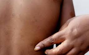 Guinea records first mpox case: Health Ministry