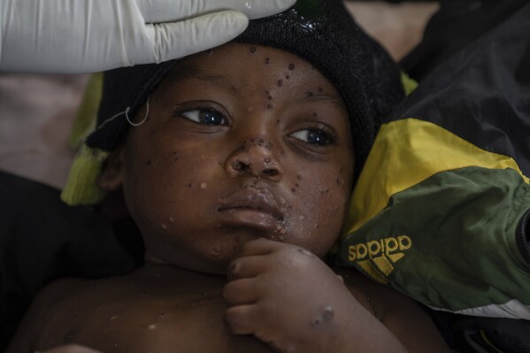 WHO says mpox cases in Congo’s epicenter where the new variant was detected may be ‘plateauing’