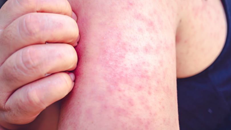 Health Alert Issued For Local Measles Outbreak In Australia’s Victoria State